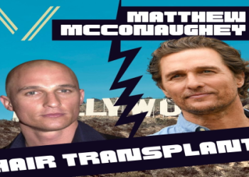 Did Conor McGregor Get a Hair Transplant? Full Story and Photo Evidence