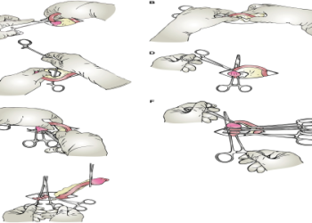 von Wagner Surgery Recovery: Timeline and Tips