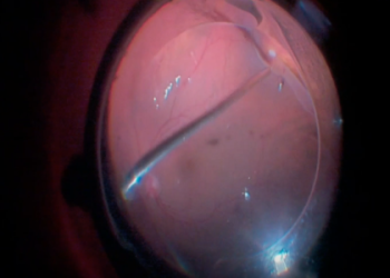 When do you need PPVS surgery? Find out which common eye problems this procedure can fix.